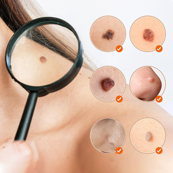 Penna Laser Plasma Rimozione Imperfezioni 15 Livelli