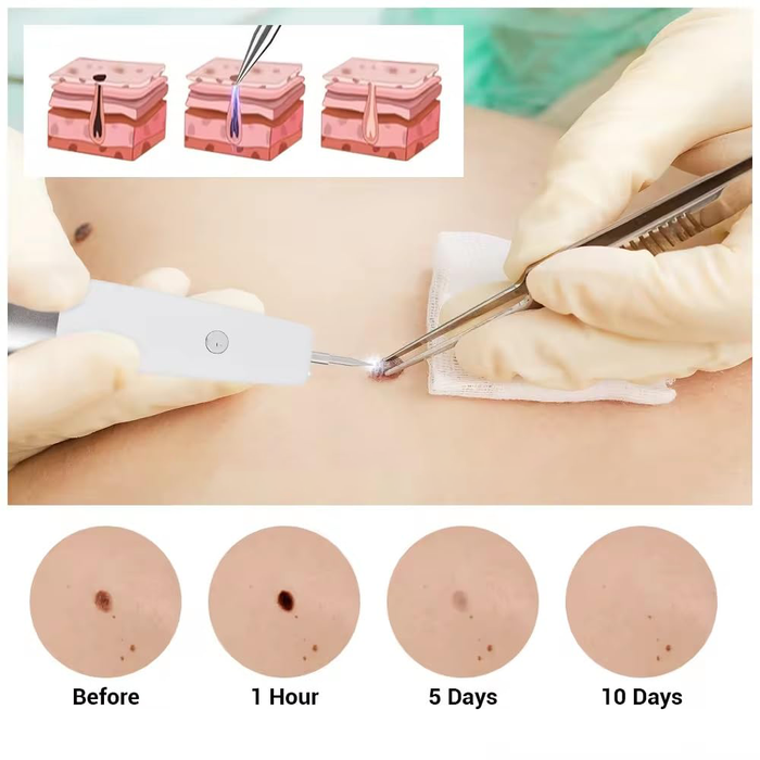 Penna Laser Plasma Rimozione Imperfezioni 15 Livelli