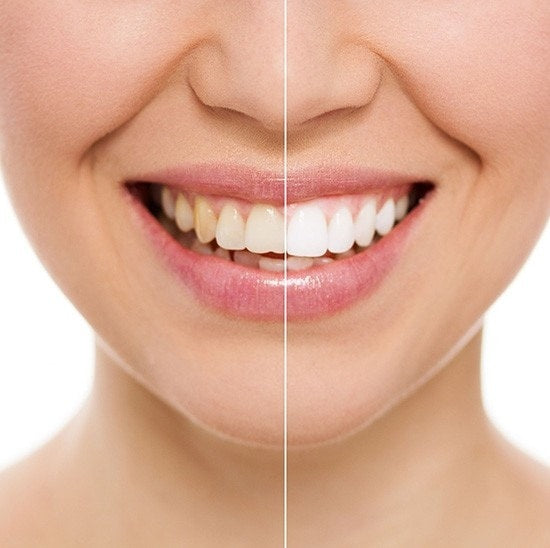 Kit sbiancamento denti a casa